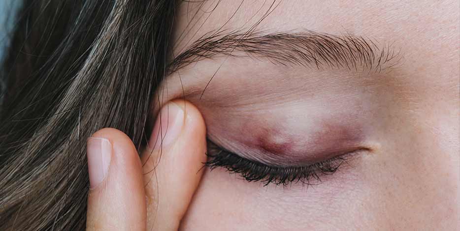 Woman points to her closed eyelid with a stye