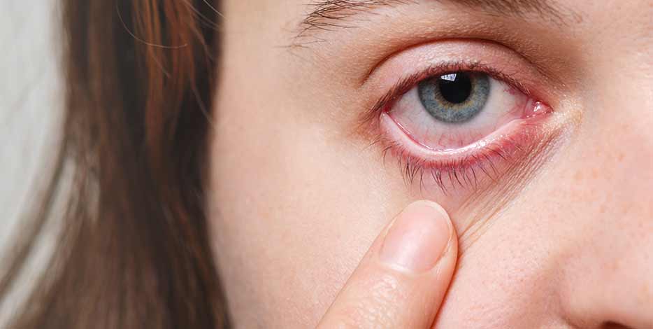 Woman points to her inflated red eye with blood capillaries