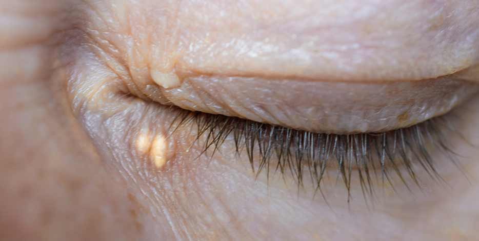 Close up of closed eyelid of older person with xanthelasma