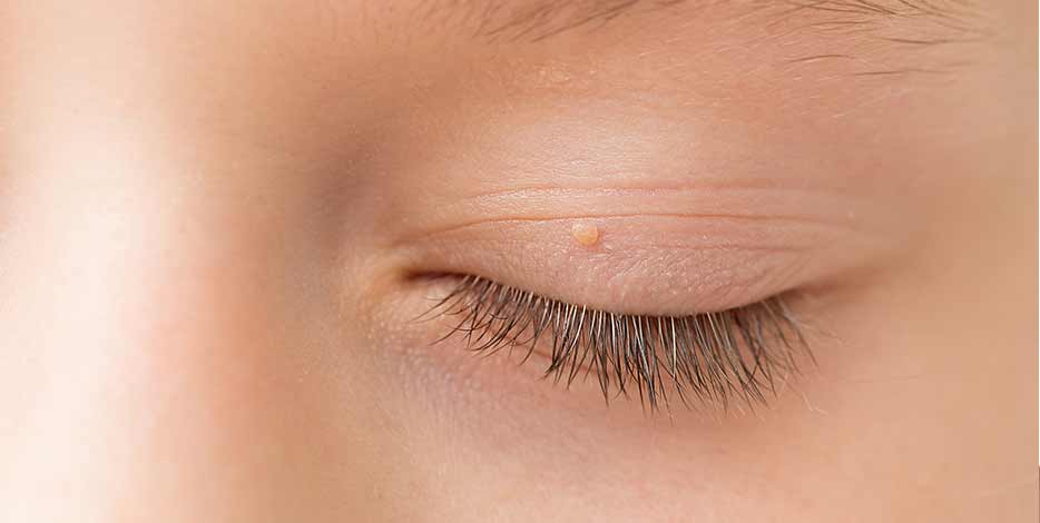 Macro shot close up of eyelid lump on closed eyelid