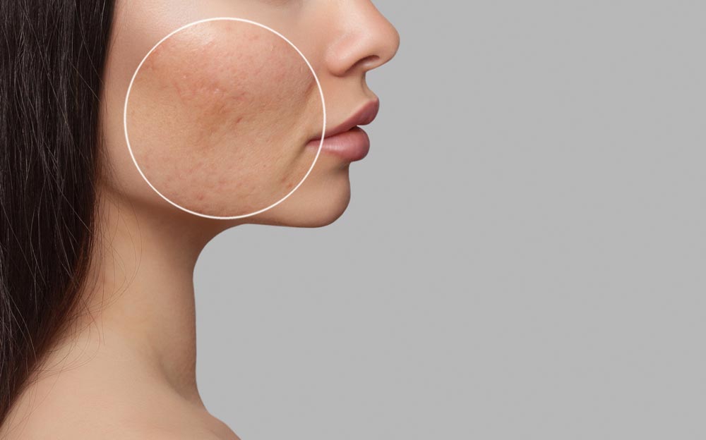 Woman side profile with skin imperfections highlighted