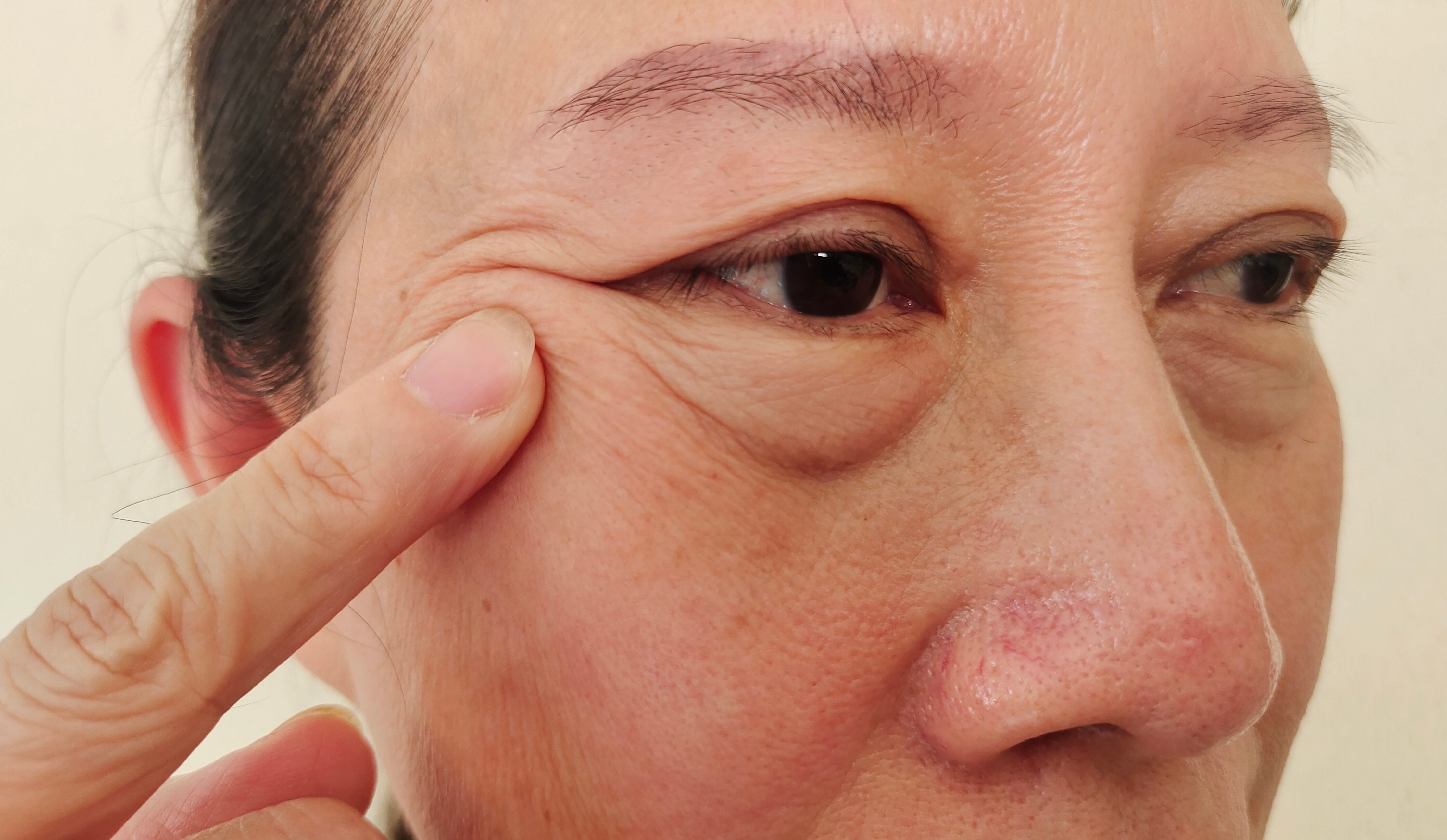 Treatment for Under Eye Bags: Eyelid Surgery Las Vegas | Nuance