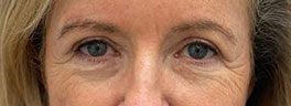 Client brow lift after photo