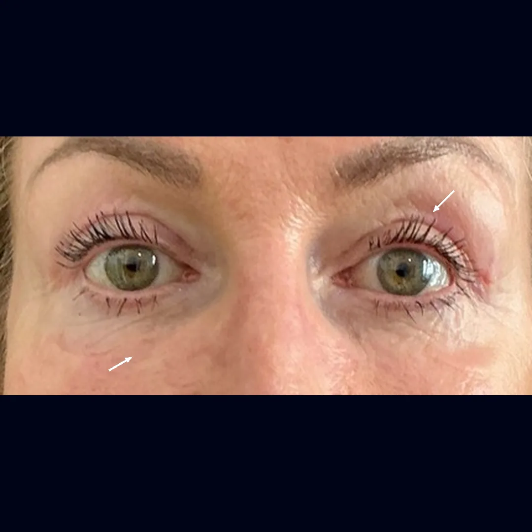 After upper blepharoplasty and festoon removal by Dr Elizabeth Hawkes, arrows indicating the healed upper lid and smoothed cheek