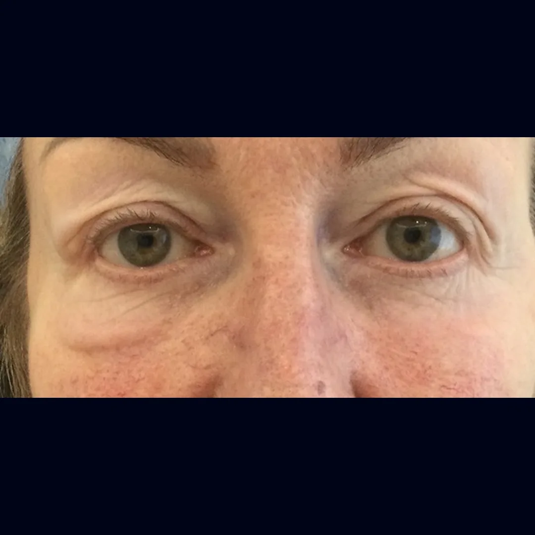 Before upper blepharoplasty and festoon removal by Dr Elizabeth Hawkes