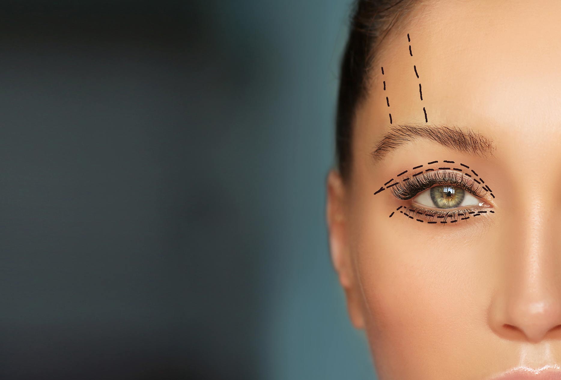 Lower and upper Blepharoplasty marking the face.