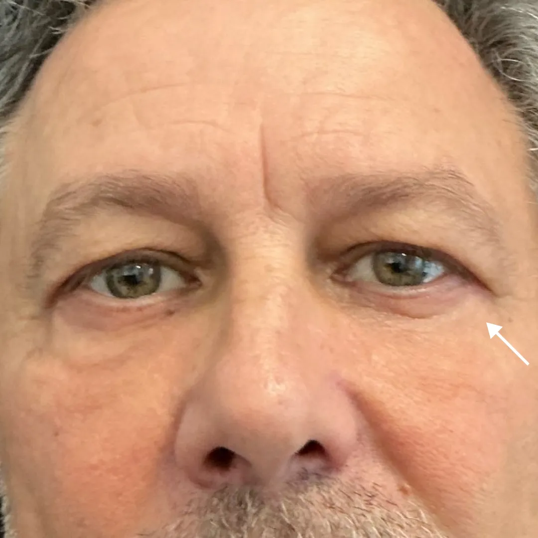 After — patient result by Dr Elizabeth Hawkes