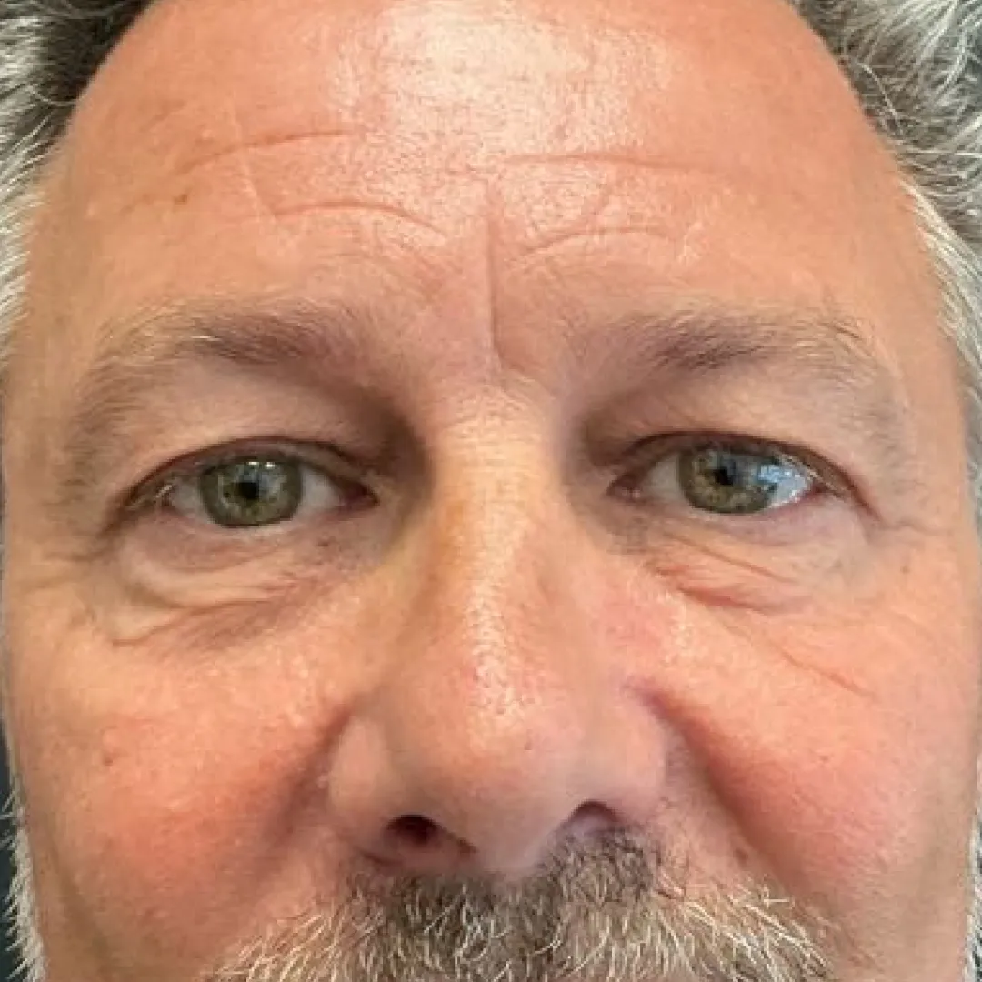 Before — patient result by Dr Elizabeth Hawkes