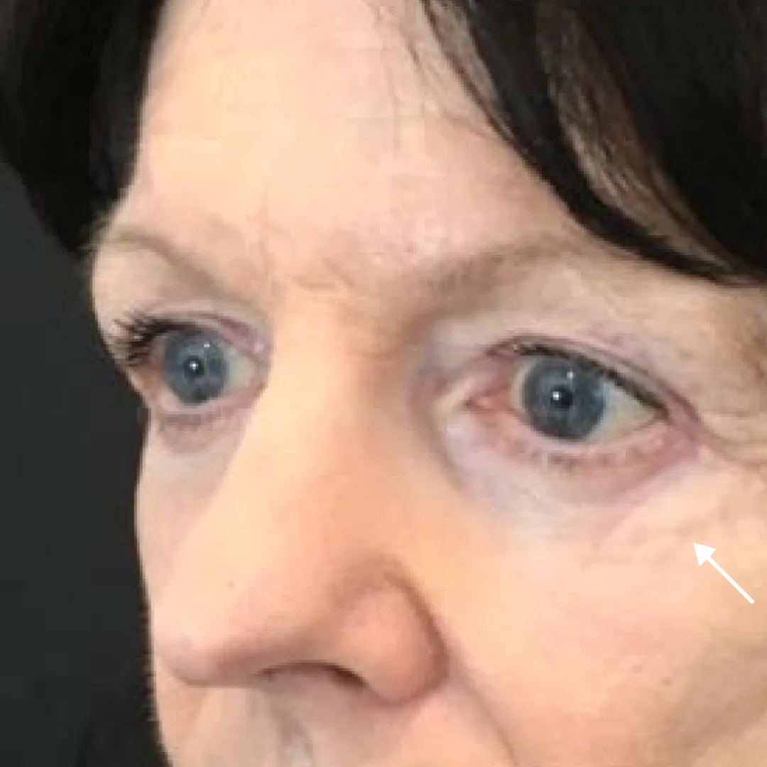 After — patient result by Dr Elizabeth Hawkes