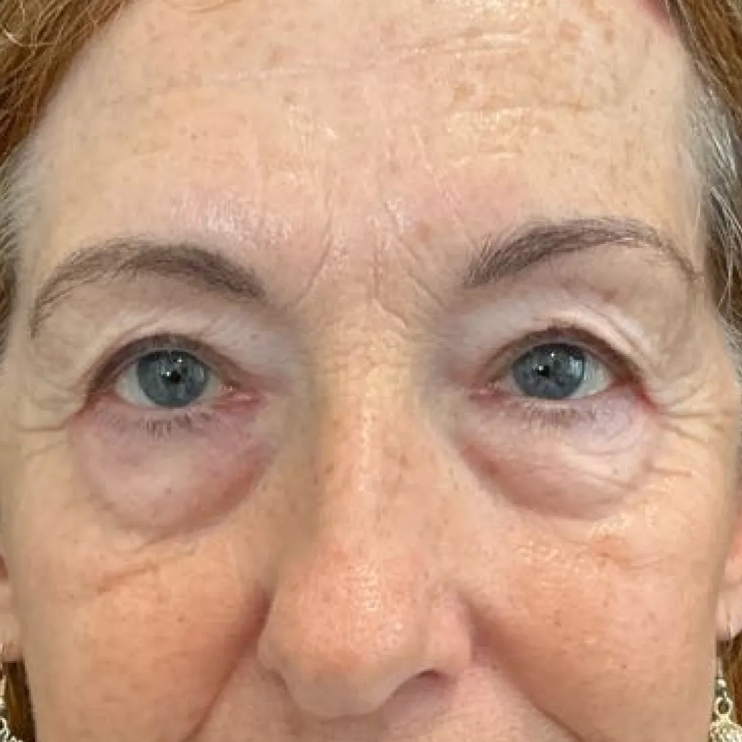 Before — patient result by Dr Elizabeth Hawkes