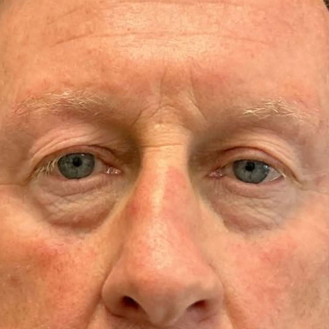 Before — patient result by Dr Elizabeth Hawkes