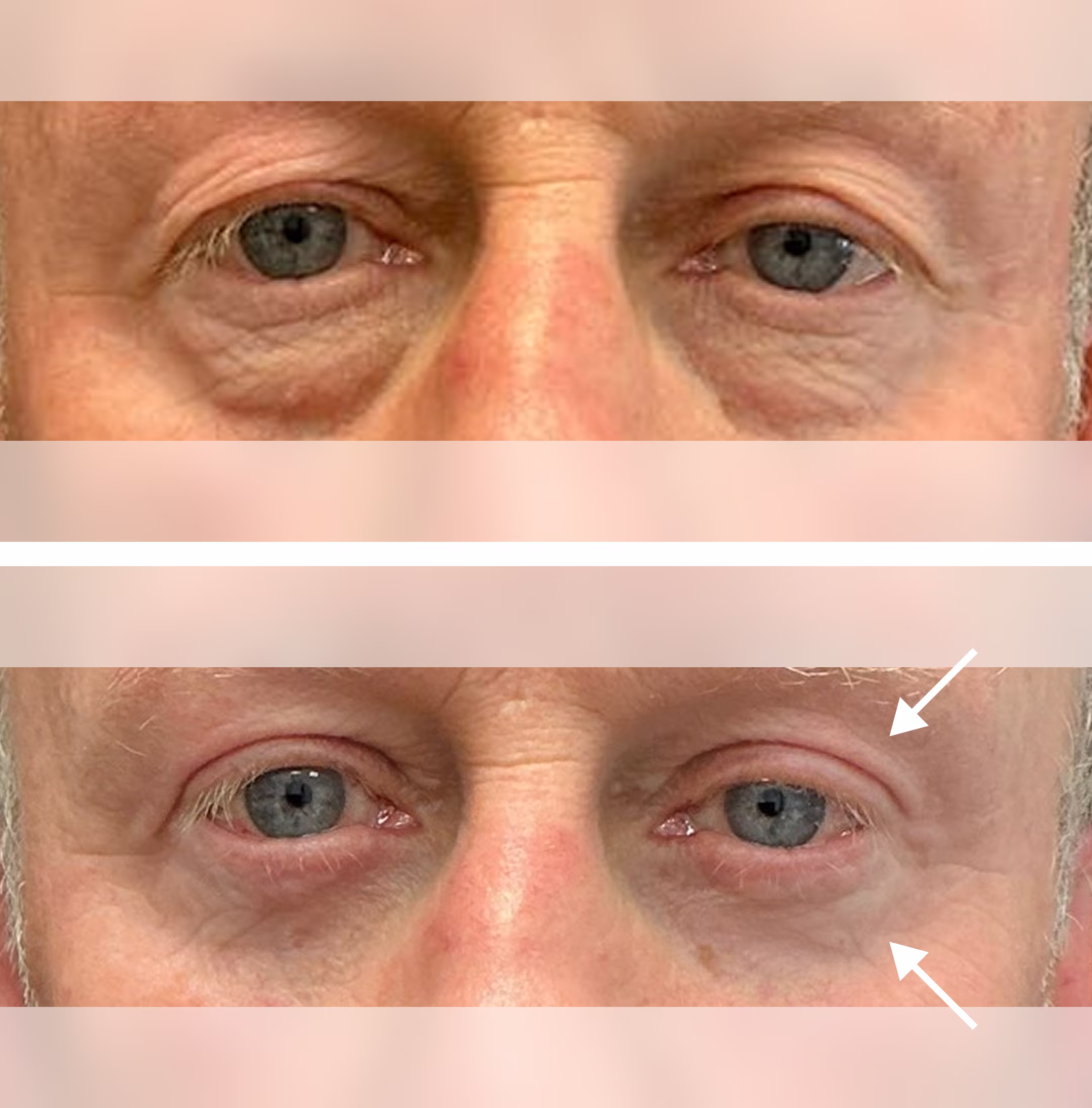 Upper and lower blepharoplasty performed by Dr Elizabeth Hawkes FRCOphth MBBS BSc