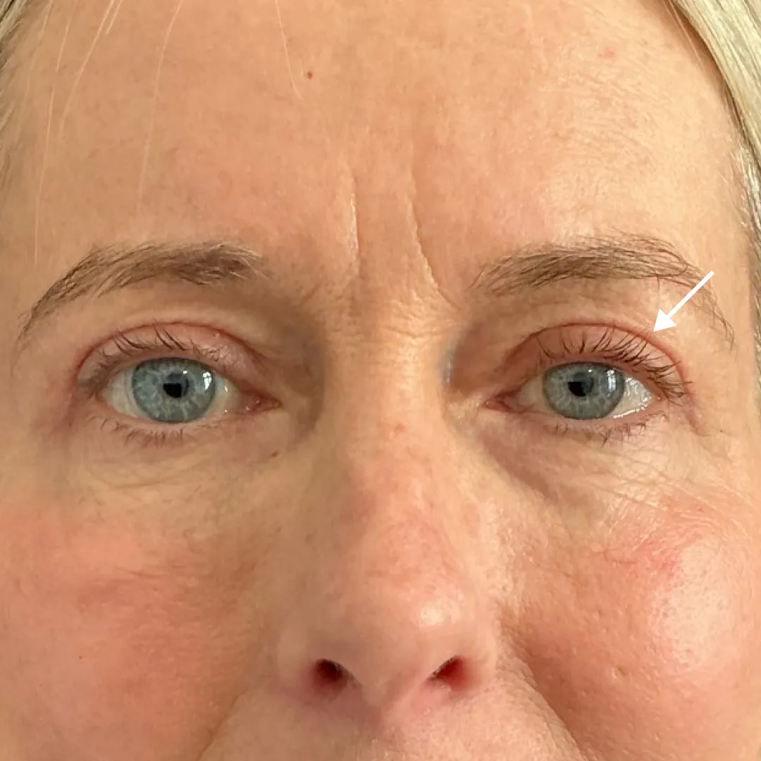After — patient result by Dr Elizabeth Hawkes