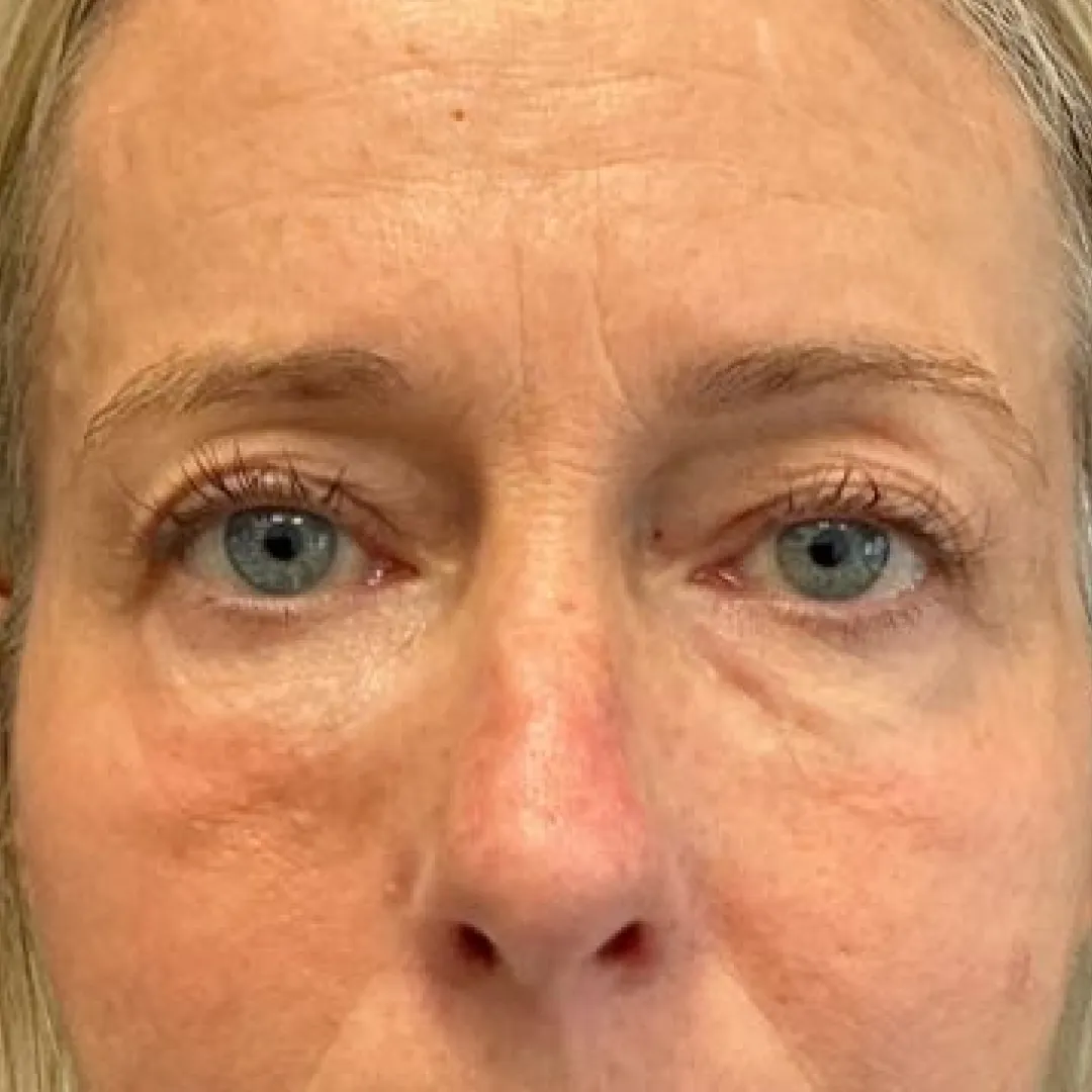 Before — patient result by Dr Elizabeth Hawkes